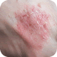 Psoriasis